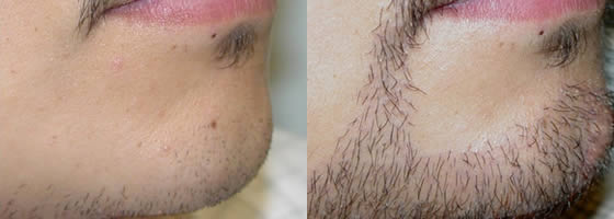 minoxidil barbe efficace ou pas